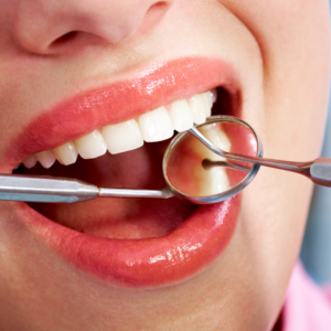 Dental Fillings in Las Vegas