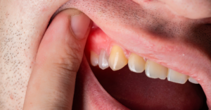 Abscessed Tooth - Emergency Dental of Las Vegas