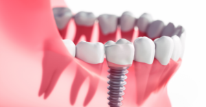 Implants - Emergency Dental of Las Vegas