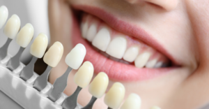 Whitening 1 - Emergency Dental of Las Vegas