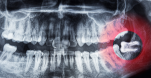 wisdom teeth - Emergency Dental of Las Vegas